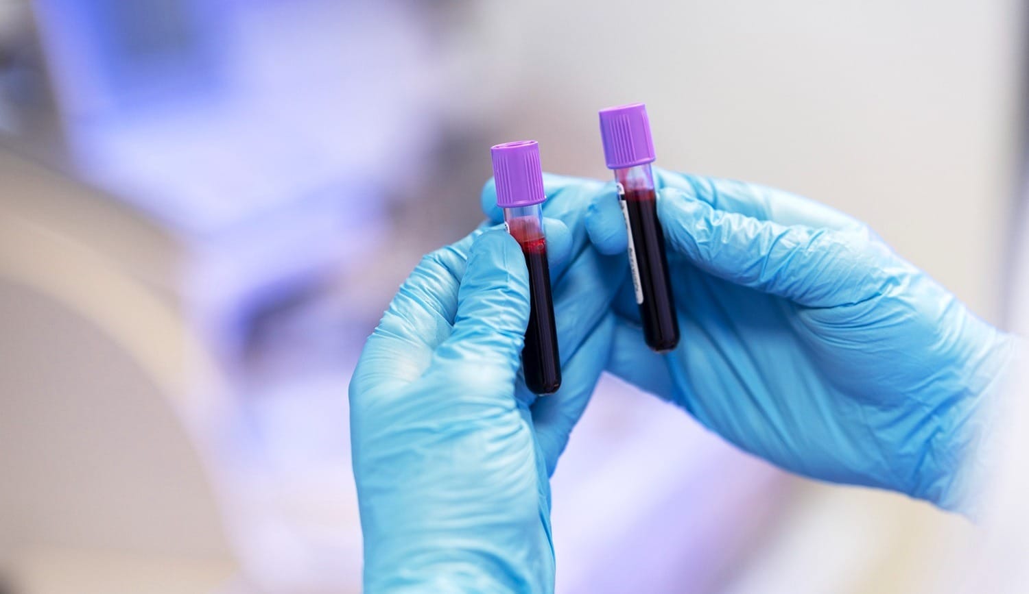 histamine-intolerance-test-blood-doctor-appointment Histamine Intolerance Test. Blood test vials for histamine intolerance DAO enzyme testing in medical laboratory for